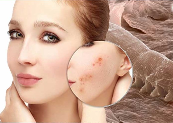 Acne on the face. Causes and treatment of folk remedies, antibiotics, herbs in adolescents and adults at home