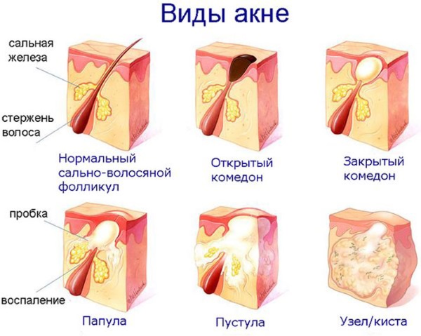 Acne on the face. Causes and treatment of folk remedies, antibiotics, herbs in adolescents and adults at home