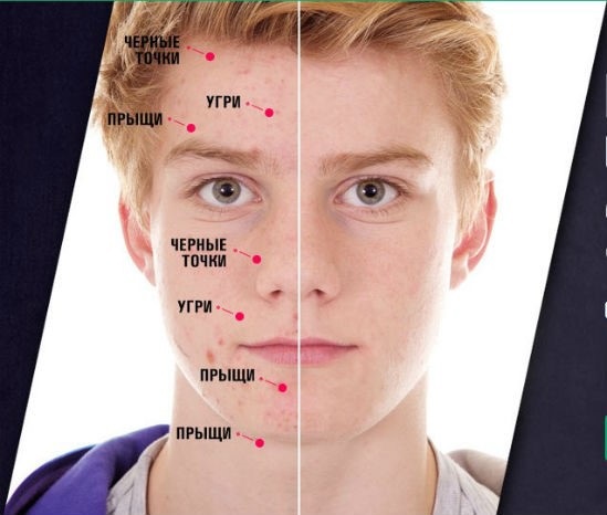 Acne on the face. Causes and treatment of folk remedies, antibiotics, herbs in adolescents and adults at home