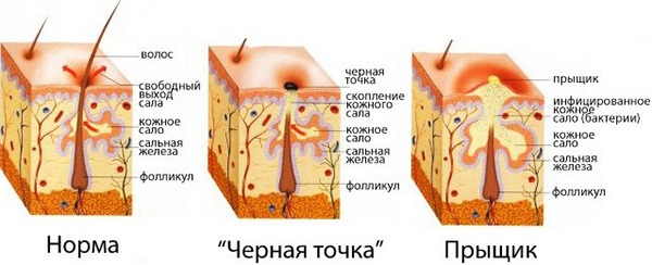 Acne on the face. Causes and treatment of folk remedies, antibiotics, herbs in adolescents and adults at home