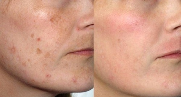 Skin care after face peeling: laser, chemical, fruit, glycolic, hardware, retinol, Jessner, yellow, TCA, bodyag, salicylic acid