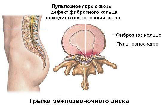 Exercises for the spine on a ball according to Bubnovsky, with osteochondrosis and hernia of the lumbar spine