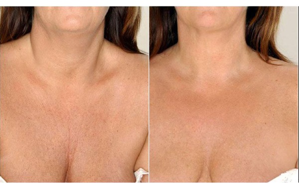 Juvederm-Hydrat zur Biorevitalisierung. Beschreibung des Arzneimittels, Zusammensetzung, Gebrauchsanweisung, Ergebnisse auf dem Foto, Preis, Bewertungen von Kosmetikerinnen