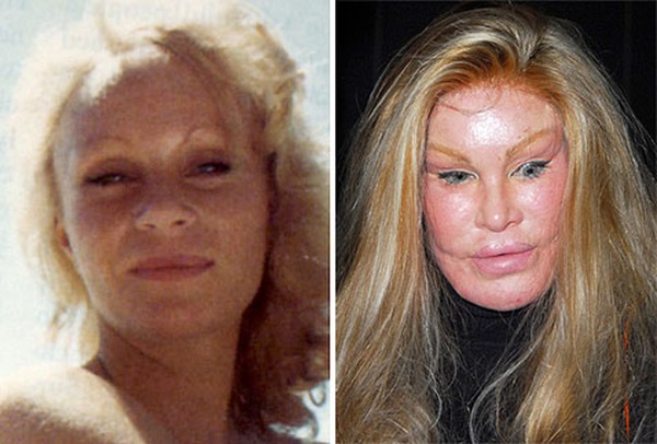 Plastic surgery victims: Russian celebrities and stars around the world, men and women. Before and after photos