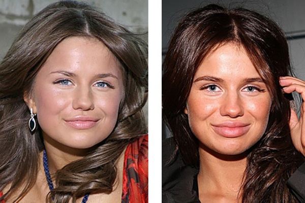 Plastic surgery victims: Russian celebrities and stars around the world, men and women. Before and after photos