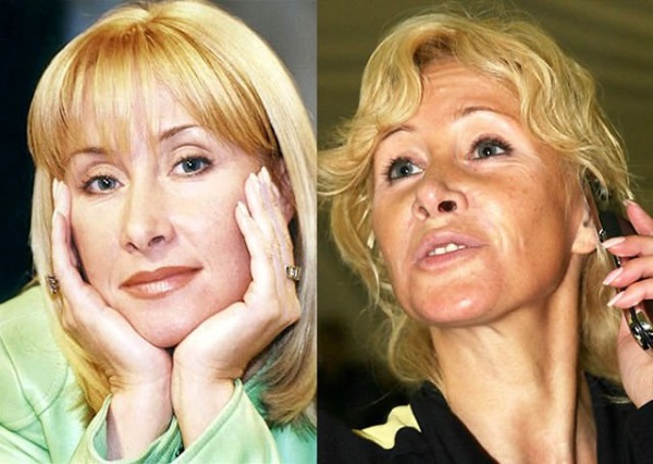 Plastic surgery victims: Russian celebrities and stars around the world, men and women. Before and after photos