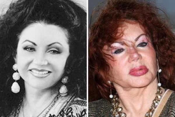 Plastic surgery victims: Russian celebrities and stars around the world, men and women. Before and after photos