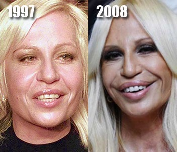 Plastic surgery victims: Russian celebrities and stars around the world, men and women. Before and after photos