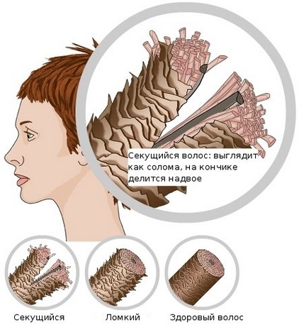 I capelli grassi alle radici e su tutta la lunghezza, secchi alle estremità, cadono. Cause e trattamento: shampoo, maschere, oli, balsami