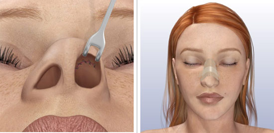 Rhinoplasty of the nose, non-surgical, closed, open, reconstructive, injection, rehabilitation