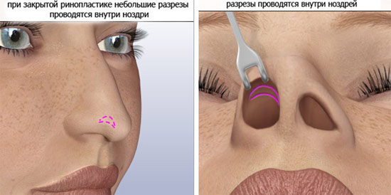 Rhinoplasty of the nose, non-surgical, closed, open, reconstructive, injection, rehabilitation