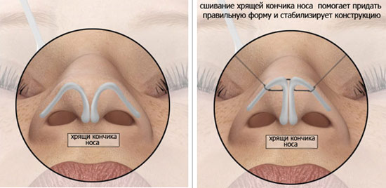 Rhinoplasty of the nose, non-surgical, closed, open, reconstructive, injection, rehabilitation