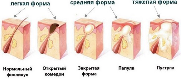 Antibiotics for acne on the face: tablets, ointment, cream, gel, injections