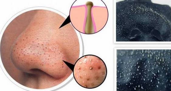 Antibiotics for acne on the face: tablets, ointment, cream, gel, injections