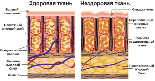 How to make an anti-cellulite massage to yourself at home with vacuum cans, honey, belly