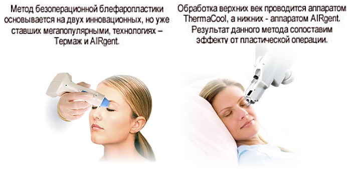 Blepharoplasty. Photos before and after the operation of the lower, upper eyelids, laser, circular, injection plastic surgery of the eyelids. How is the operation, rehabilitation, reviews and prices