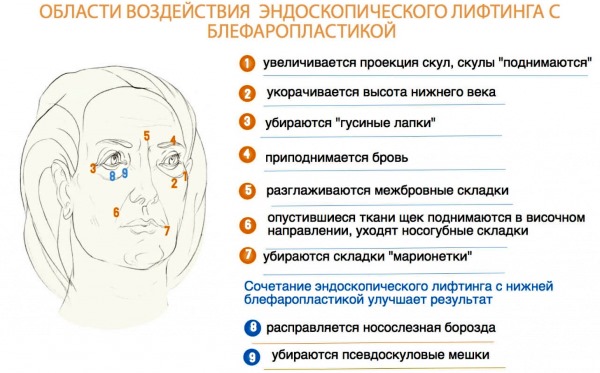 Blepharoplasty. Photos before and after the operation of the lower, upper eyelids, laser, circular, injection plastic surgery of the eyelids. How is the operation, rehabilitation, reviews and prices