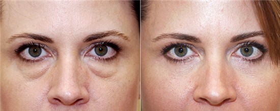 Blepharoplasty. Photos before and after the operation of the lower, upper eyelids, laser, circular, injection plastic surgery of the eyelids. How is the operation, rehabilitation, reviews and prices