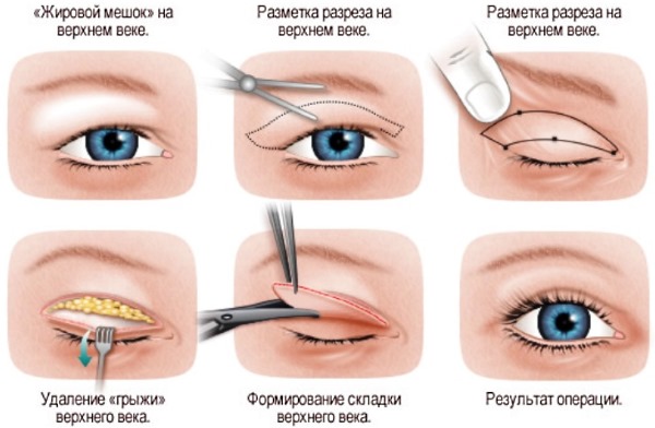 Blepharoplasty. Photos before and after the operation of the lower, upper eyelids, laser, circular, injection plastic surgery of the eyelids. How is the operation, rehabilitation, reviews and prices