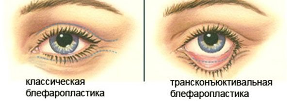 Blepharoplasty. Photos before and after the operation of the lower, upper eyelids, laser, circular, injection plastic surgery of the eyelids. How is the operation, rehabilitation, reviews and prices