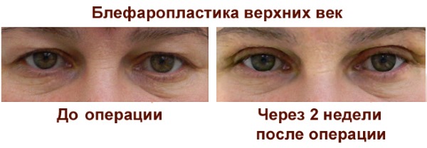 Blepharoplasty. Photos before and after the operation of the lower, upper eyelids, laser, circular, injection plastic surgery of the eyelids. How is the operation, rehabilitation, reviews and prices