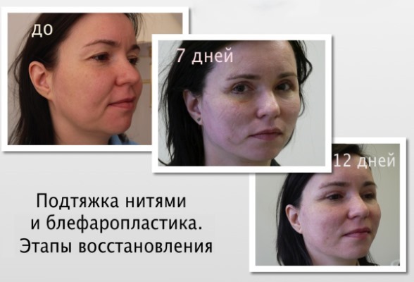 Blepharoplasty. Photos before and after the operation of the lower, upper eyelids, laser, circular, injection plastic surgery of the eyelids. How is the operation, rehabilitation, reviews and prices