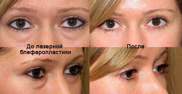 Blepharoplasty. Photos before and after the operation of the lower, upper eyelids, laser, circular, injection plastic surgery of the eyelids. How is the operation, rehabilitation, reviews and prices