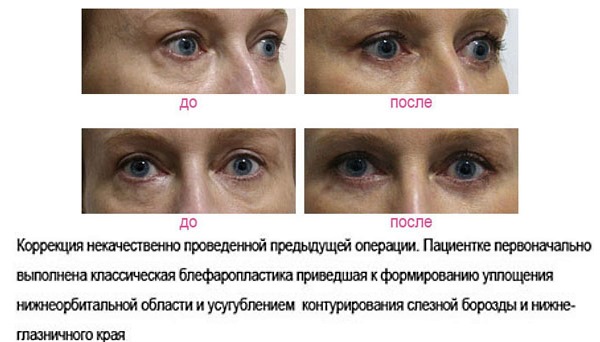 Blepharoplasty. Photos before and after the operation of the lower, upper eyelids, laser, circular, injection plastic surgery of the eyelids. How is the operation, rehabilitation, reviews and prices