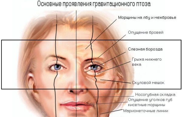 Blepharoplasty. Photos before and after the operation of the lower, upper eyelids, laser, circular, injection plastic surgery of the eyelids. How is the operation, rehabilitation, reviews and prices