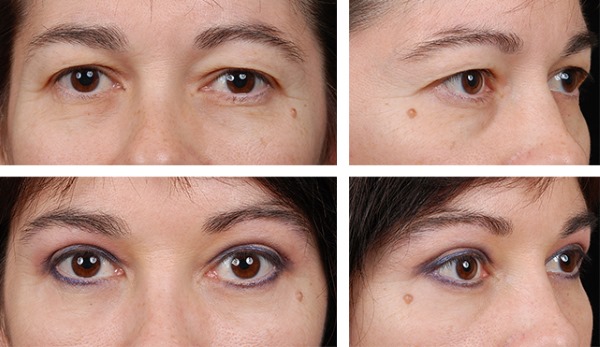 Blepharoplasty. Photos before and after the operation of the lower, upper eyelids, laser, circular, injection plastic surgery of the eyelids. How is the operation, rehabilitation, reviews and prices