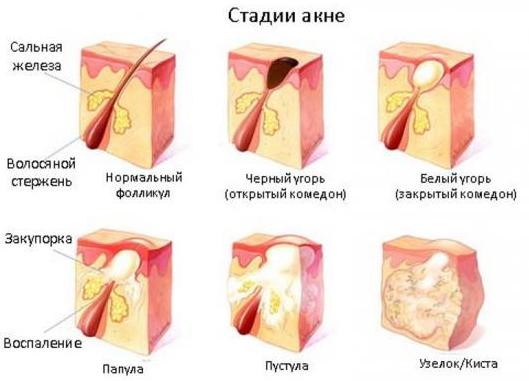 Talker for acne. Dermatologist's recipe with Levomycetin and Salicylic acid. How to prepare and use