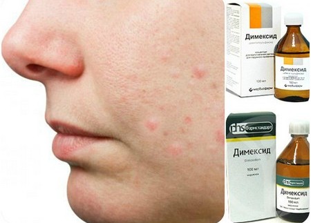 Talker for acne. Dermatologist's recipe with Levomycetin and Salicylic acid. How to prepare and use