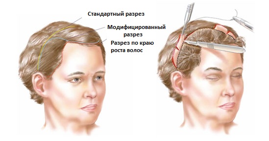 Endoscopic facelift: forehead and eyebrows, neck, cheekbones, temporal part. How is it done, photos, rehabilitation and consequences