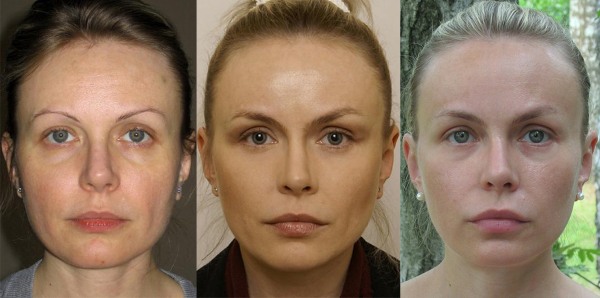 Endoscopic facelift: forehead and eyebrows, neck, cheekbones, temporal part. How is it done, photos, rehabilitation and consequences