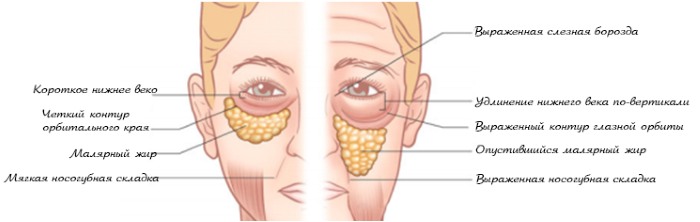 Endoscopic facelift: forehead and eyebrows, neck, cheekbones, temporal part. How is it done, photos, rehabilitation and consequences