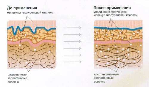 Fillers based on hyaluronic acid. Names, types, action, application effects, prices and reviews