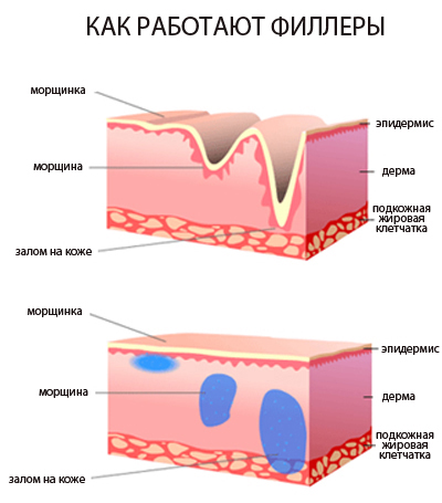 Fillers based on hyaluronic acid. Names, types, action, application effects, prices and reviews