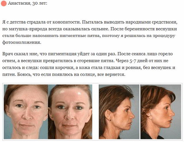 Photorejuvenation of the face - what is it, pros and cons, before and after photos, indications and contraindications