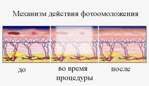 Photorejuvenation of the face - what is it, pros and cons, before and after photos, indications and contraindications