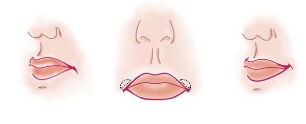 Cheiloplasty of the lips: before and after photos, types, indications and contraindications. How is the operation and rehabilitation going?