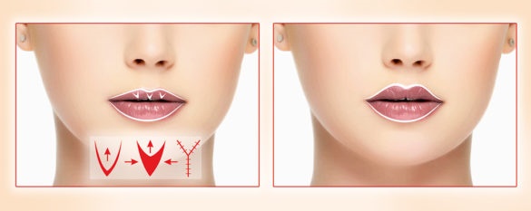 Cheiloplasty of the lips: before and after photos, types, indications and contraindications. How is the operation and rehabilitation going?