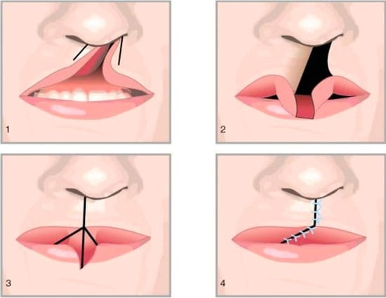 Cheiloplastica delle labbra: foto prima e dopo, tipologie, indicazioni e controindicazioni. Come stanno andando l'operazione e la riabilitazione?