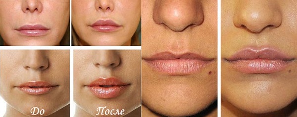 Cheiloplasty of the lips: before and after photos, types, indications and contraindications. How is the operation and rehabilitation going?