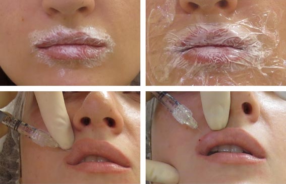 Cheiloplasty of the lips: before and after photos, types, indications and contraindications. How is the operation and rehabilitation going?