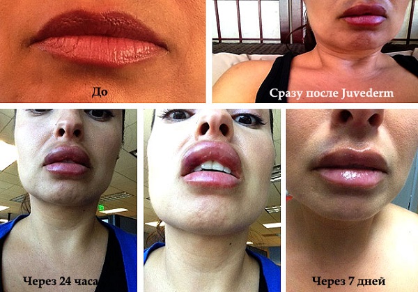 Cheiloplasty of the lips: before and after photos, types, indications and contraindications. How is the operation and rehabilitation going?