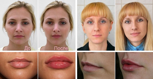 Cheiloplasty of the lips: before and after photos, types, indications and contraindications. How is the operation and rehabilitation going?