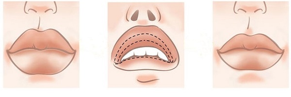 Cheiloplasty of the lips: before and after photos, types, indications and contraindications. How is the operation and rehabilitation going?