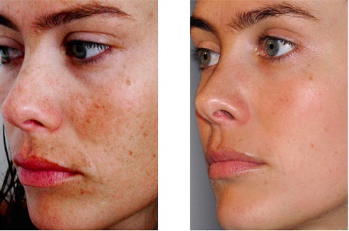 Chemical peeling for the face in the salon and at home. Reviews, before and after photos, pros and cons