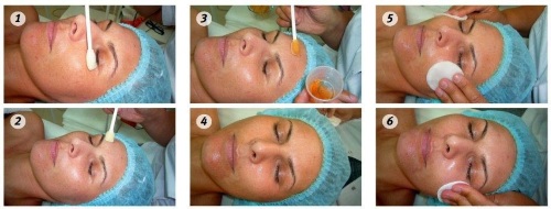 Chemical peeling for the face in the salon and at home. Reviews, before and after photos, pros and cons