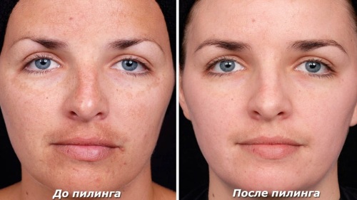 Chemical peeling for the face in the salon and at home. Reviews, before and after photos, pros and cons